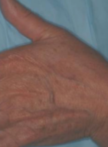 11vbeam_a._kauvar_m.d_12_weeks_post_treatments_with_perfecta_pigmented_lesion_handpiece